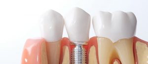 Dental Implant Simple