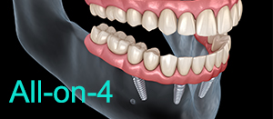 Best All-on-4 All on 4 Implant Dentist