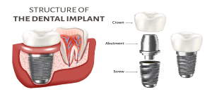 How much is Dental Implant? $1850