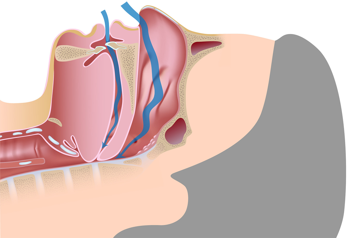 Drawing of a person's airway is completely blocked off by falling back of his tongue.
