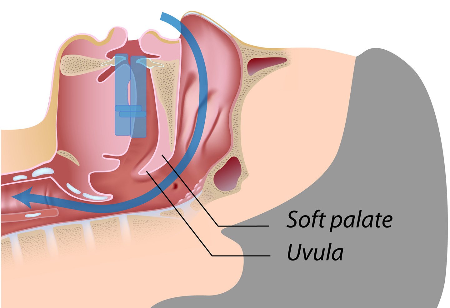Drawing of a person with oral appliance therapy. His tongue is lifted off the back of his throat, therefore he is breathing easily through his nose.