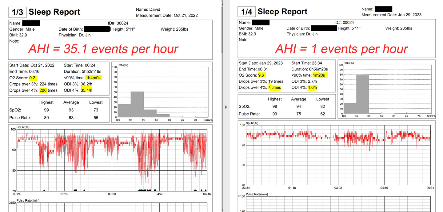 Sleep test results showing 35.1 events per hour before OAT, and 1 event per hour using OAT