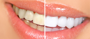 Best Teeth Whitening in New Jersey