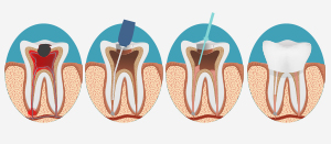 Root Canal Therapy A Beautiful Smile Dentistry Ft Lee New Jersey